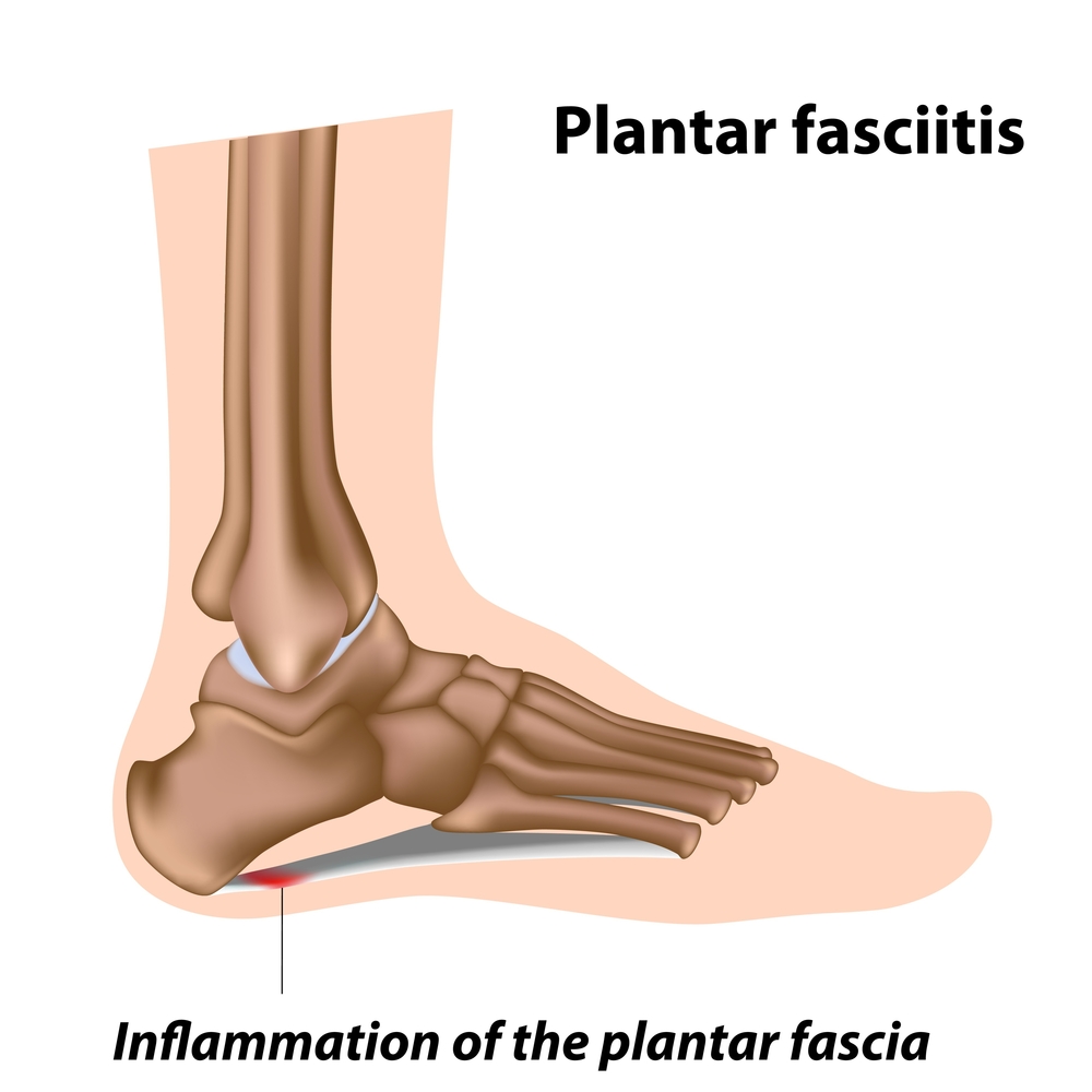 Physiotherapy Treatment For Plantar Fasciitis | Best Treatment For Plantar  Fasciitis | UAE Plantar Fasciitis Treatment Center
